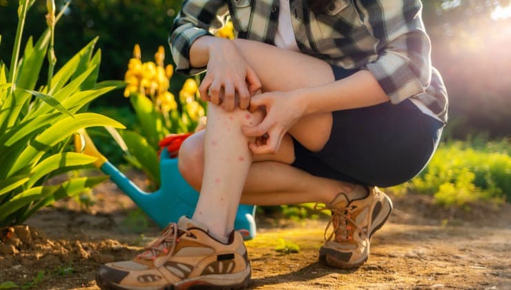 Persona si gratta le gambe, puntura di zanzare